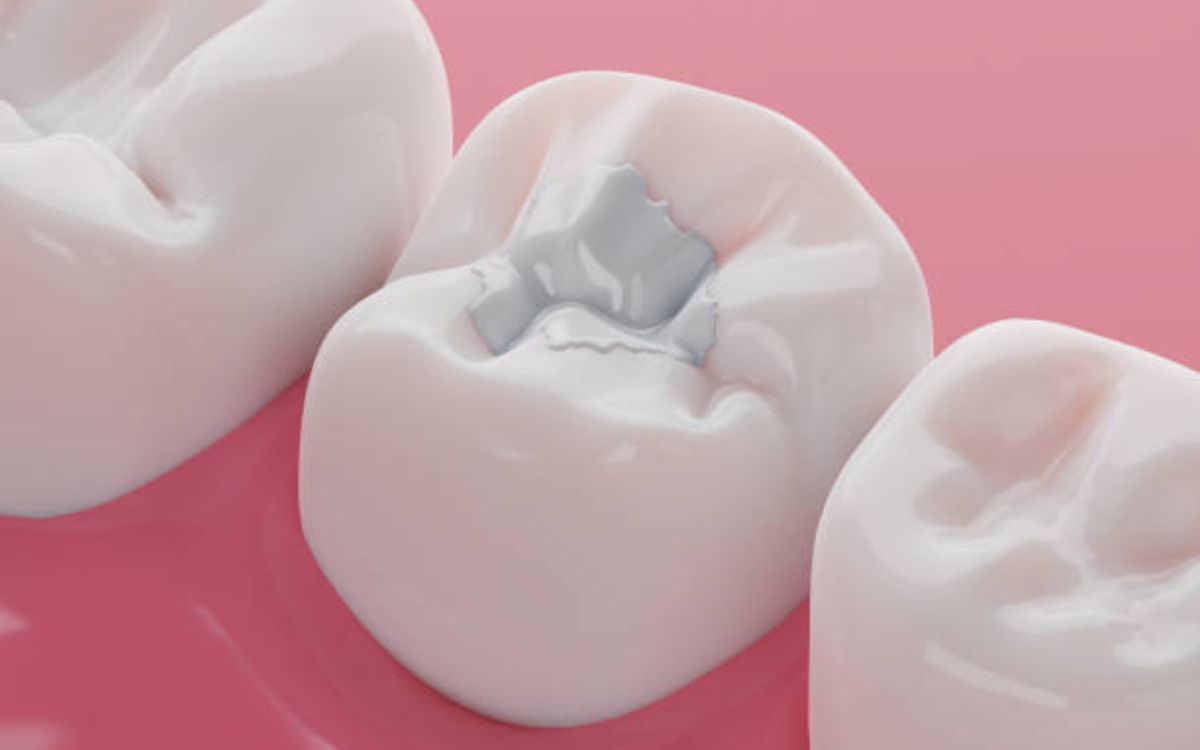Composite Fillings Last on Molars