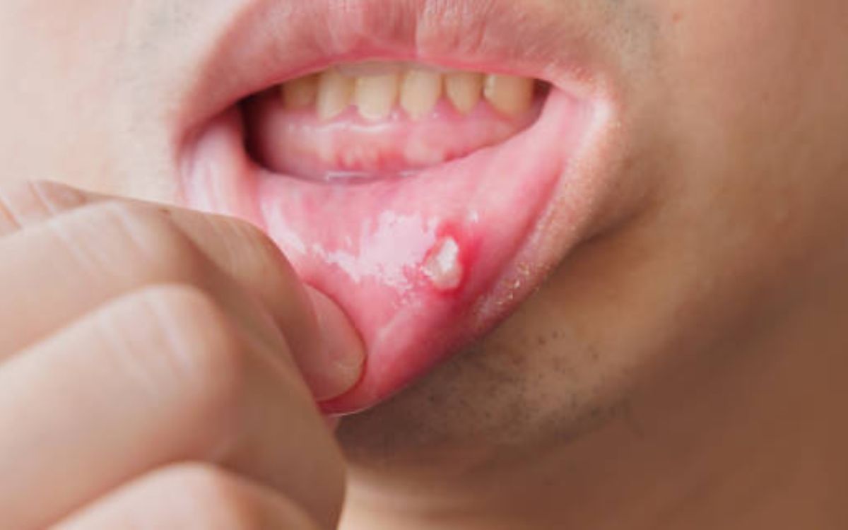 How To Stop Canker Sores From Recurring Naturally