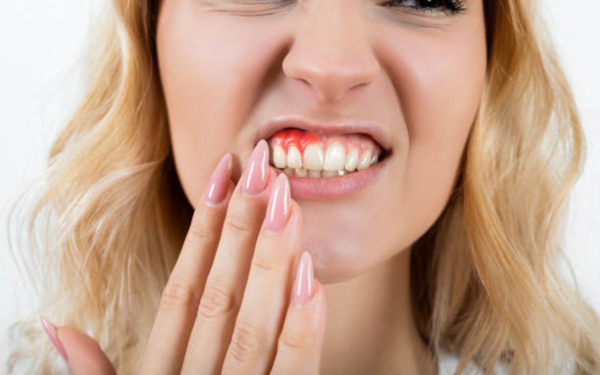 How to Stop Bleeding Gums Naturally at Home
